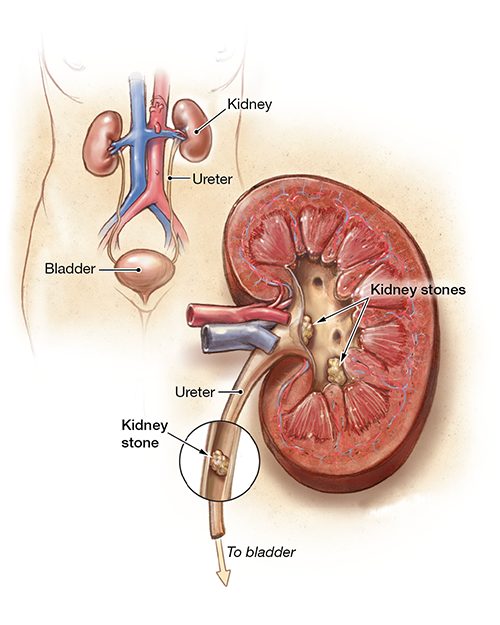 kidney stones Treatment