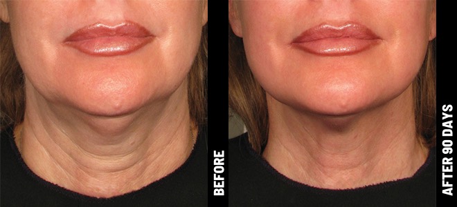 Before and After Cheek