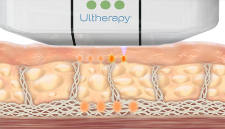 Ultherapy_Stimulates_Collagen_Production_at_Different_Layers_Skin_Tightening