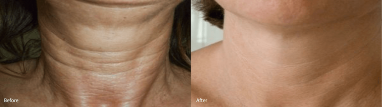 Before and after - lipokontur treatment