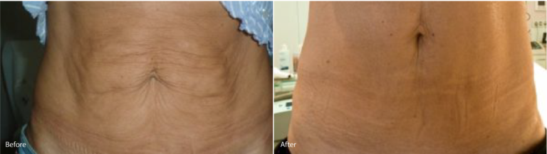 before and aft lipo (1)