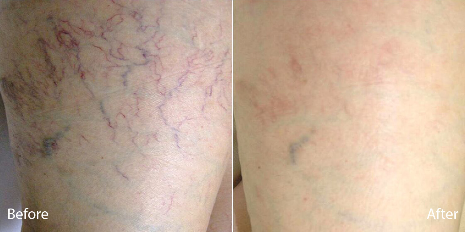 before and after - elite plus (1)