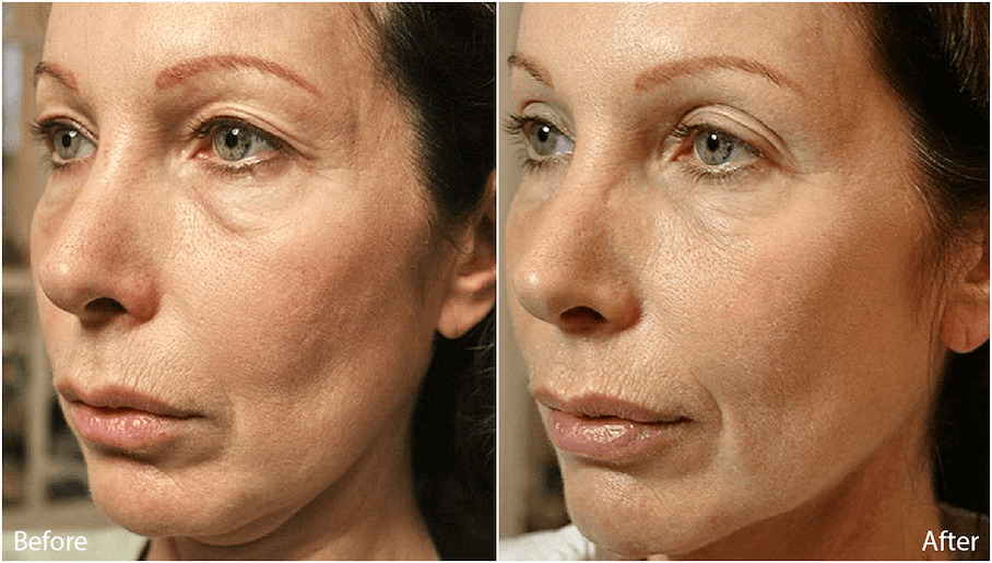 thermage (before and after) (1)